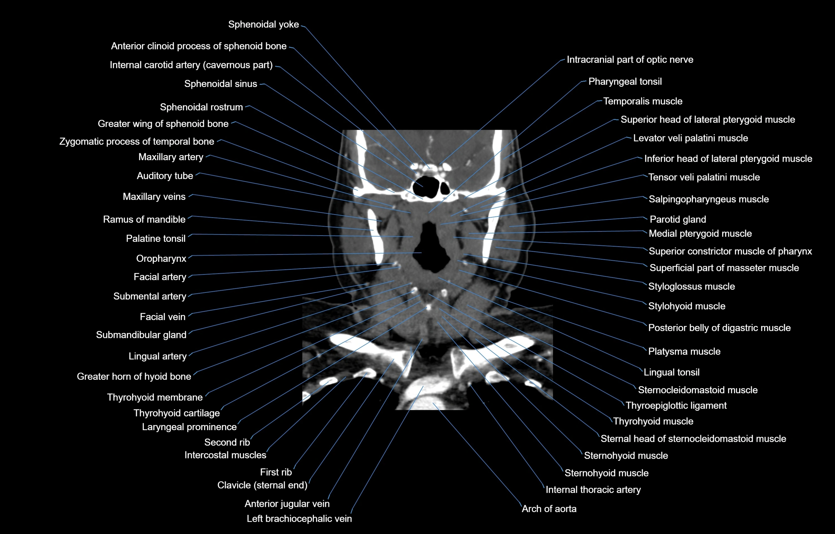 CT Neck coronal  cross sectional anatomy labelled 3D  radiology  image-00030.webp